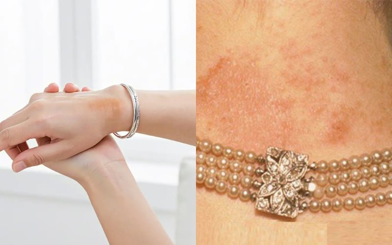 Dị ứng khi đeo trang sức